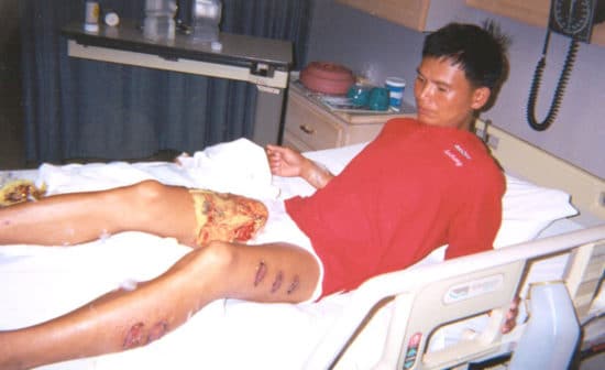 Tan Yongjie brûlé au 3ème degré en 2001