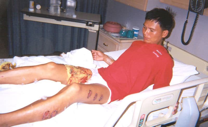 Tan Yongjie brûlé au 3ème degré en 2001