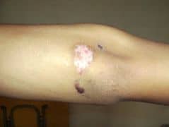 Cicatrices et contusions sur le bras de Cao Yang après qu’il a été frappé par la police, à cause de la persécution du Falun Gong